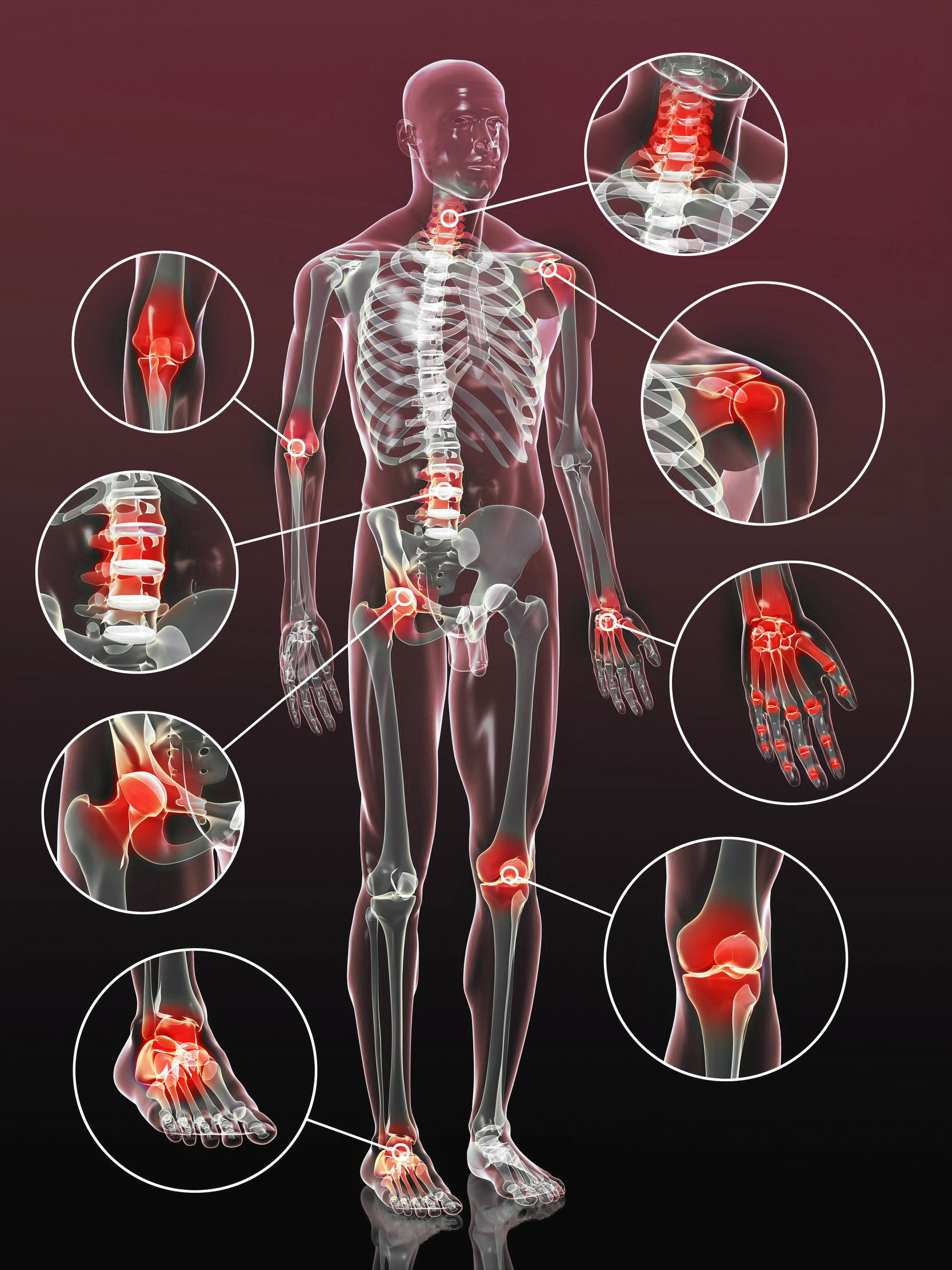 Inflamed joints throughout the body